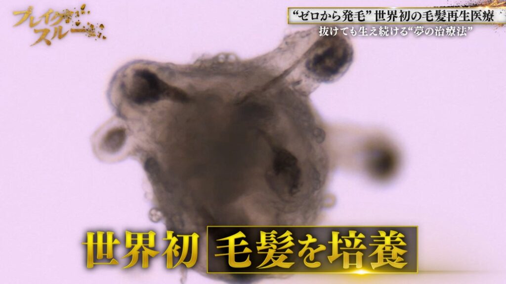 世界初の薄毛治療！抜けても生え続ける“夢の治療法”【ブレイクスルー】